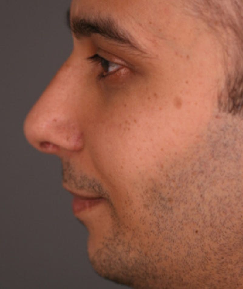 Primary Rhinoplasty Before & After Gallery - Patient 108174334 - Image 2