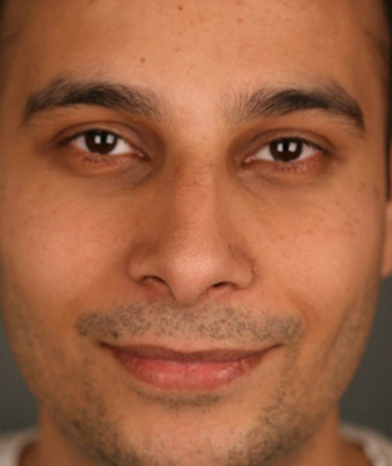 Primary Rhinoplasty Before & After Gallery - Patient 108174334 - Image 4