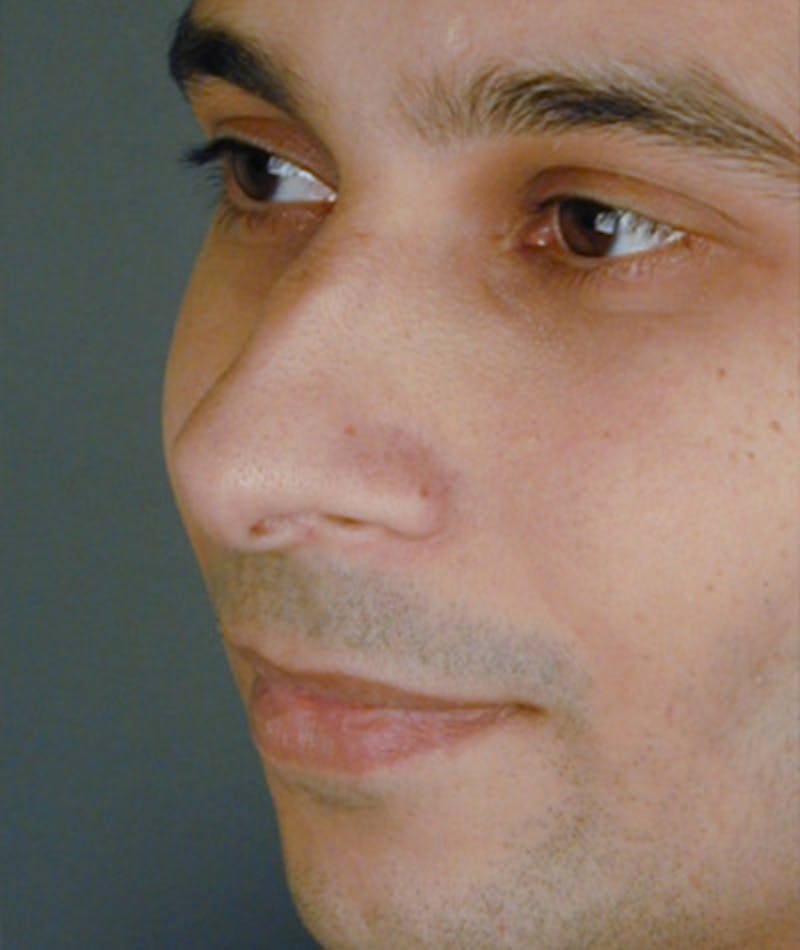 Primary Rhinoplasty Before & After Gallery - Patient 108174334 - Image 5