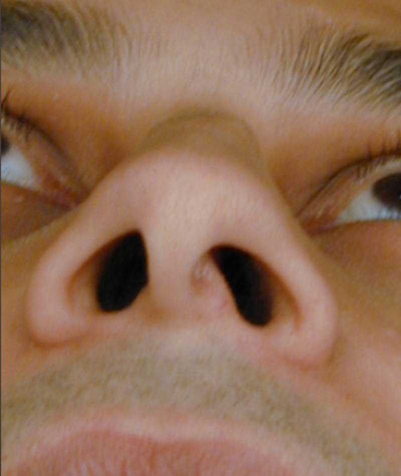 Primary Rhinoplasty Before & After Gallery - Patient 108174334 - Image 7