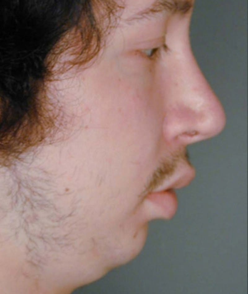 Primary Rhinoplasty Before & After Gallery - Patient 108174336 - Image 1