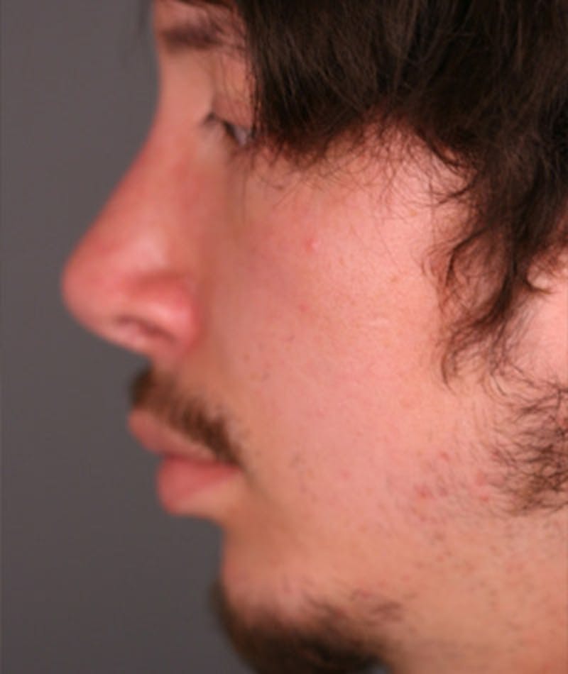 Primary Rhinoplasty Before & After Gallery - Patient 108174336 - Image 2