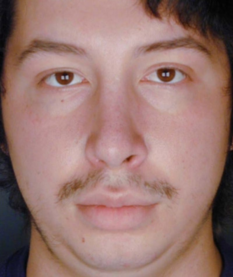 Primary Rhinoplasty Before & After Gallery - Patient 108174336 - Image 4