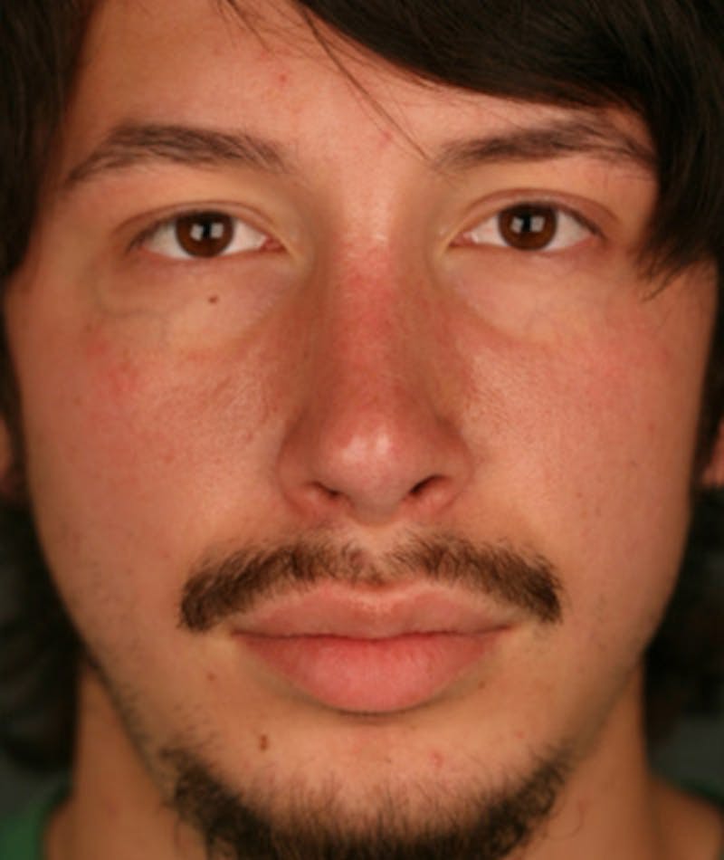 Primary Rhinoplasty Before & After Gallery - Patient 108174336 - Image 5