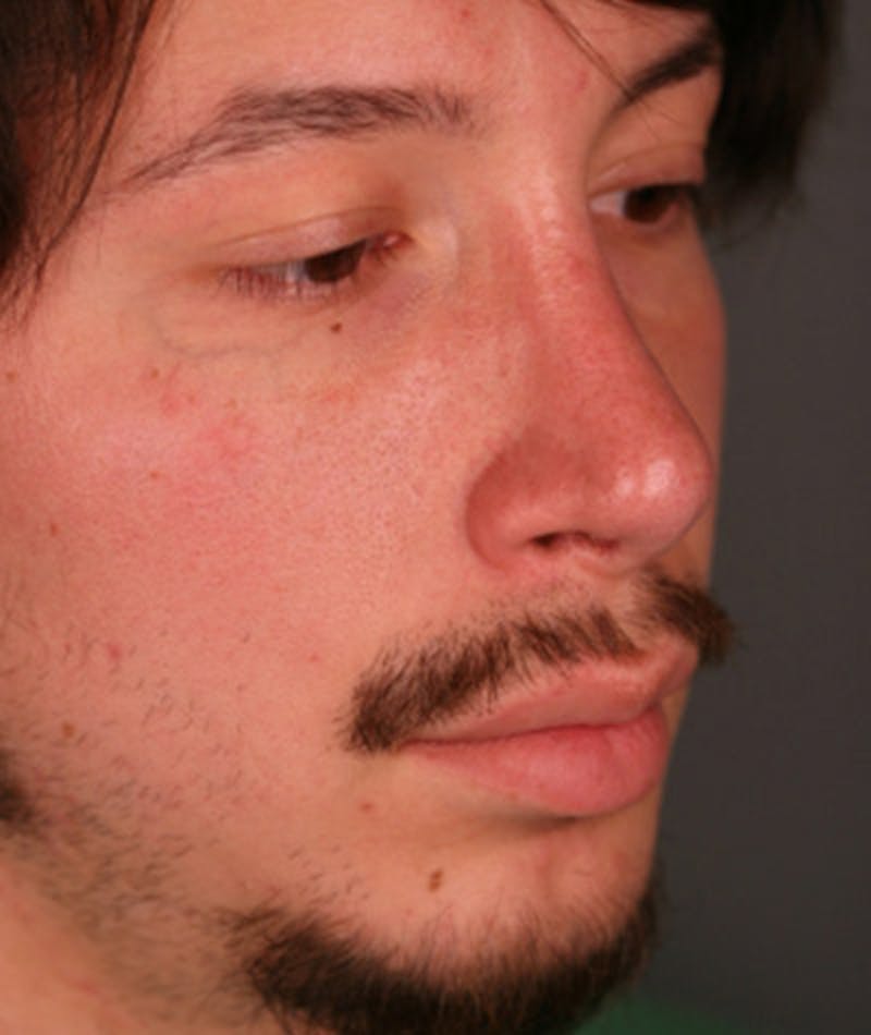Primary Rhinoplasty Before & After Gallery - Patient 108174336 - Image 6