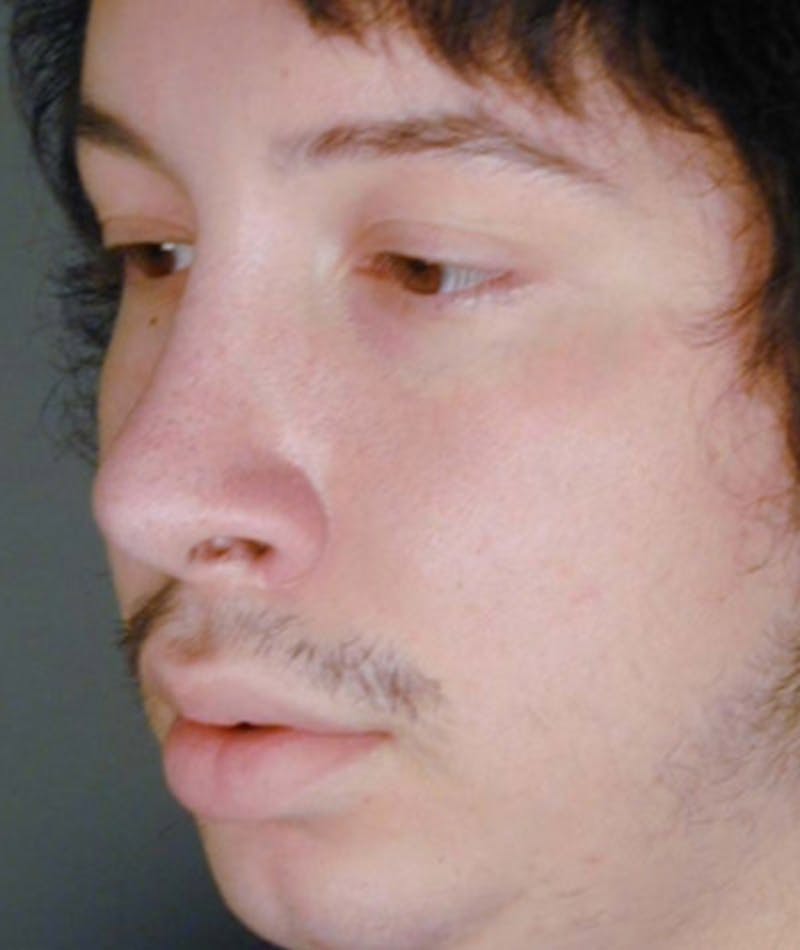 Primary Rhinoplasty Before & After Gallery - Patient 108174336 - Image 7
