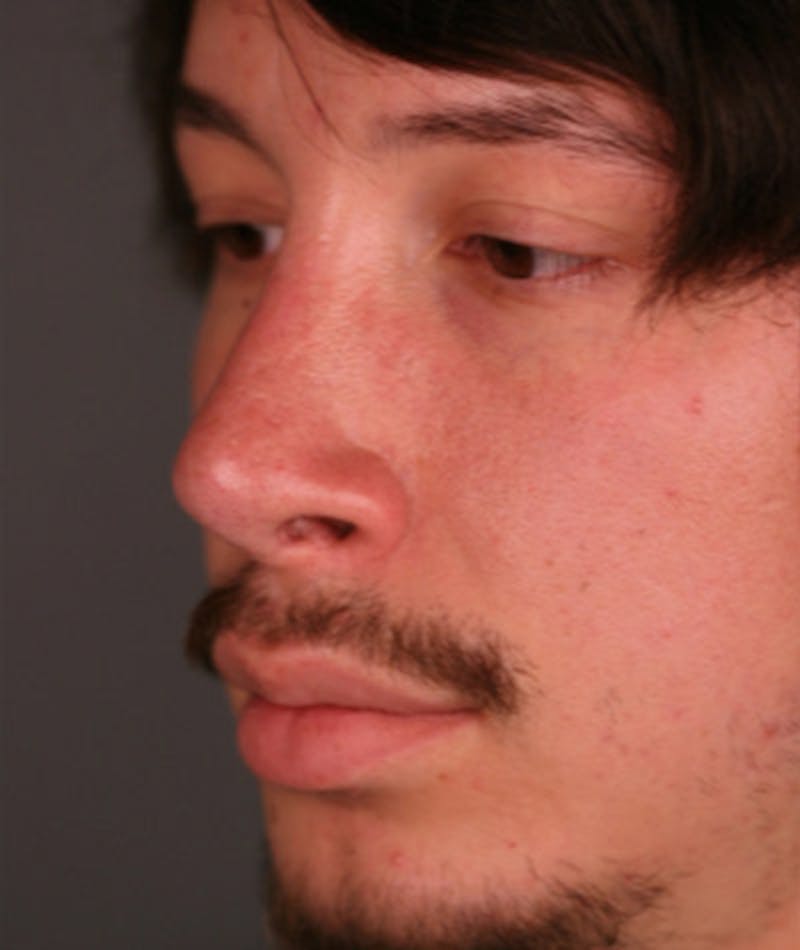 Primary Rhinoplasty Before & After Gallery - Patient 108174336 - Image 8