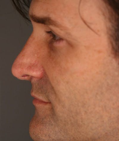 Primary Rhinoplasty Before & After Gallery - Patient 108174337 - Image 2