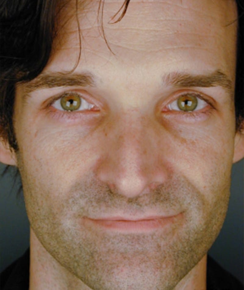 Primary Rhinoplasty Before & After Gallery - Patient 108174337 - Image 3