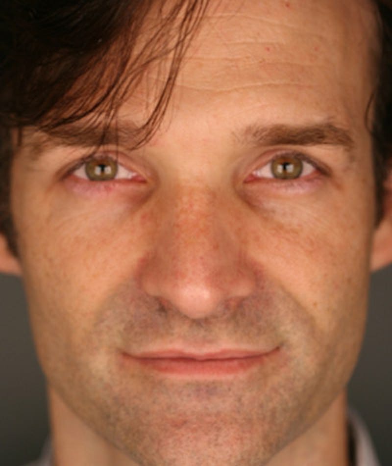 Primary Rhinoplasty Before & After Gallery - Patient 108174337 - Image 4