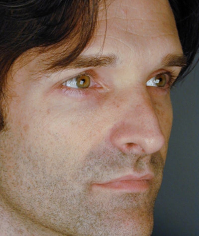 Primary Rhinoplasty Before & After Gallery - Patient 108174337 - Image 5