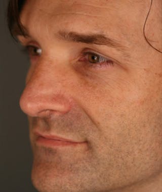 Primary Rhinoplasty Before & After Gallery - Patient 108174337 - Image 8