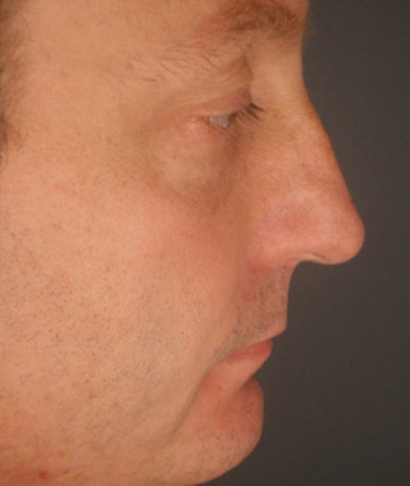 Primary Rhinoplasty Before & After Gallery - Patient 108174338 - Image 1