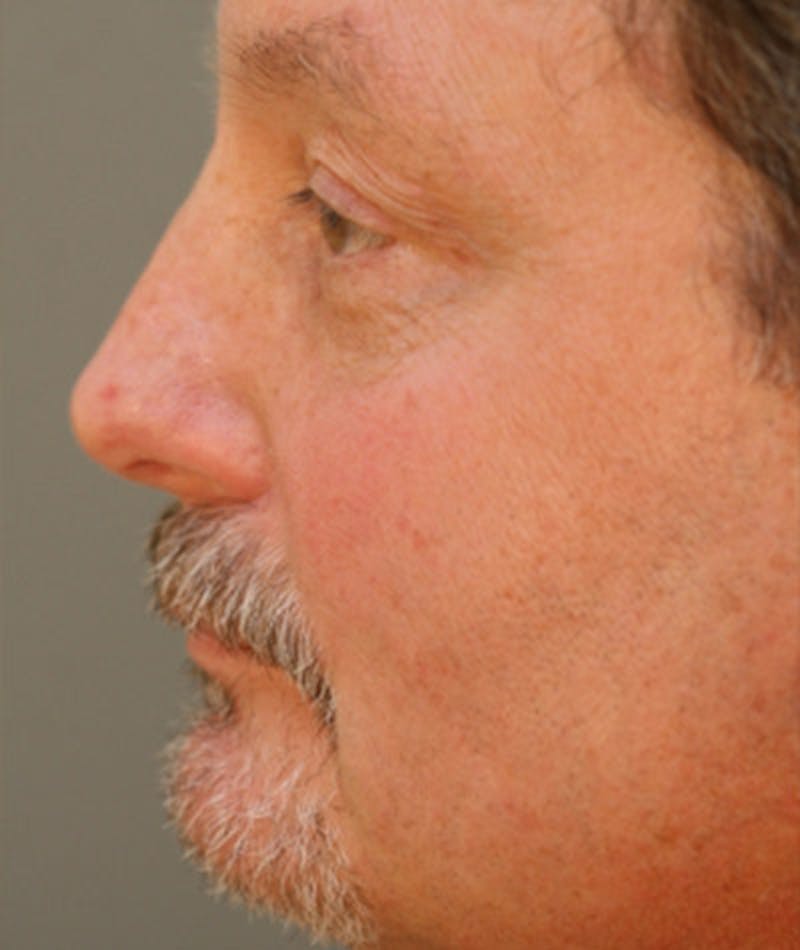 Primary Rhinoplasty Before & After Gallery - Patient 108174338 - Image 2