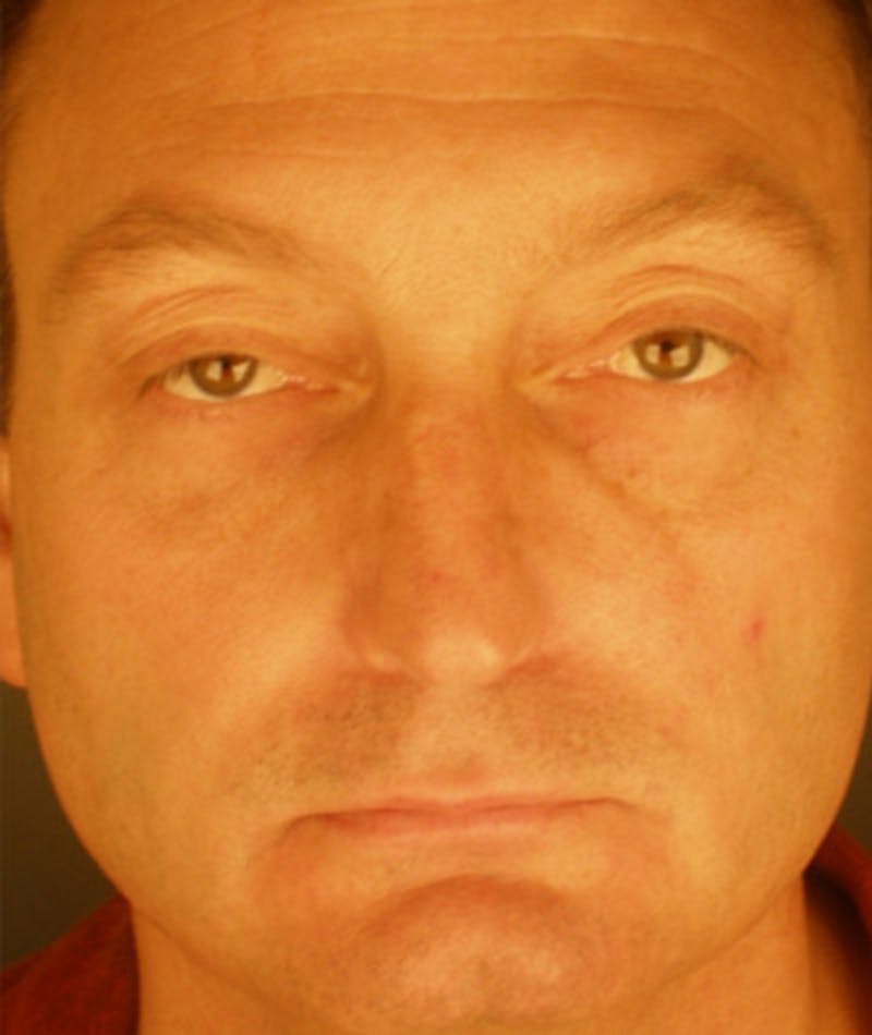 Primary Rhinoplasty Before & After Gallery - Patient 108174338 - Image 3
