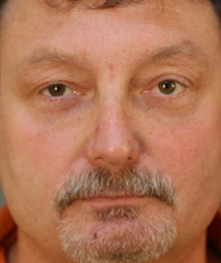 Primary Rhinoplasty Before & After Gallery - Patient 108174338 - Image 4