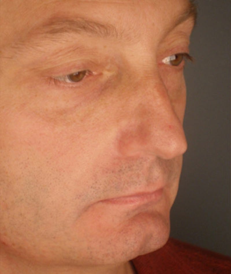 Primary Rhinoplasty Before & After Gallery - Patient 108174338 - Image 5
