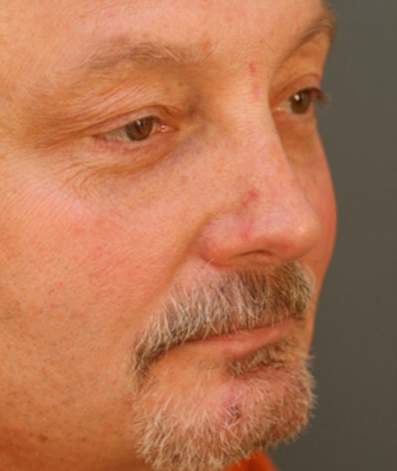 Primary Rhinoplasty Before & After Gallery - Patient 108174338 - Image 6