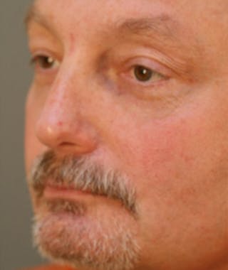 Primary Rhinoplasty Before & After Gallery - Patient 108174338 - Image 8