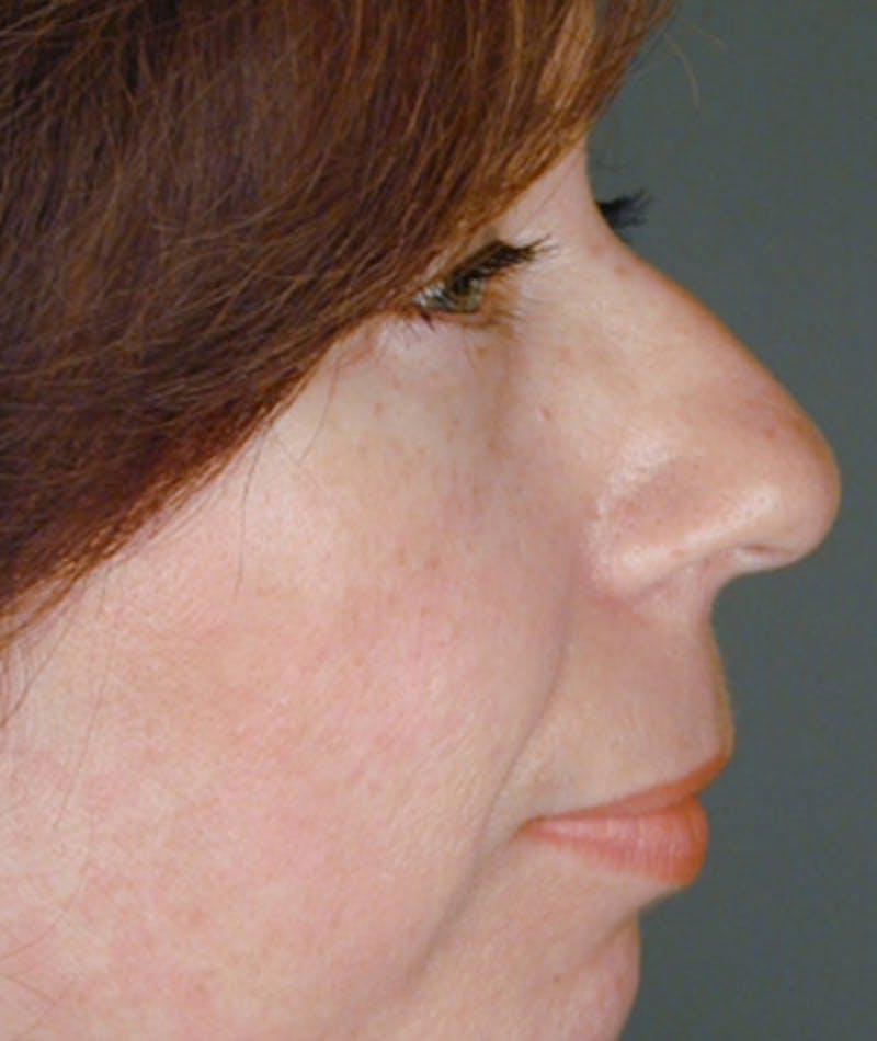 Primary Rhinoplasty Before & After Gallery - Patient 108174339 - Image 1