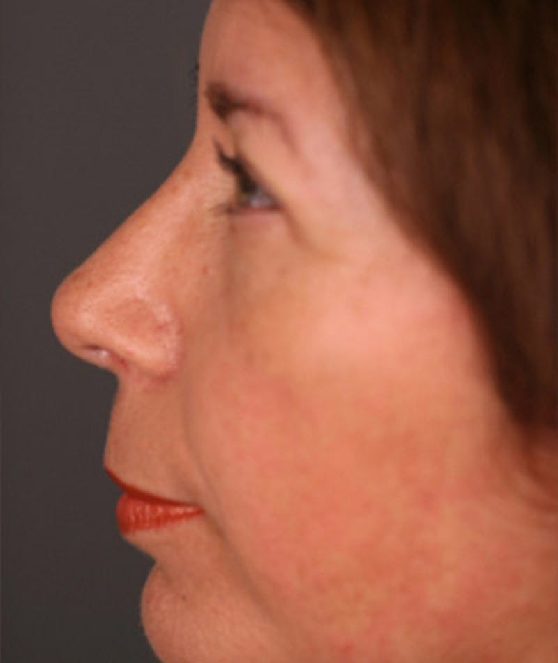 Primary Rhinoplasty Before & After Gallery - Patient 108174339 - Image 2