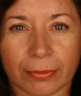 Primary Rhinoplasty Before & After Gallery - Patient 108174339 - Image 4