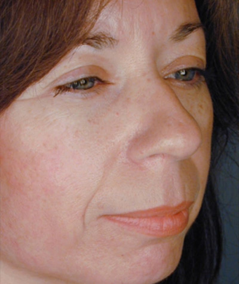 Primary Rhinoplasty Before & After Gallery - Patient 108174339 - Image 5