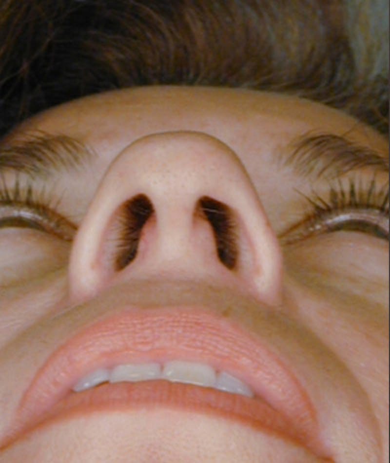 Primary Rhinoplasty Before & After Gallery - Patient 108174339 - Image 7