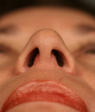 Primary Rhinoplasty Before & After Gallery - Patient 108174339 - Image 8