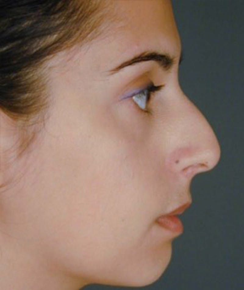 Primary Rhinoplasty Before & After Gallery - Patient 108174340 - Image 1