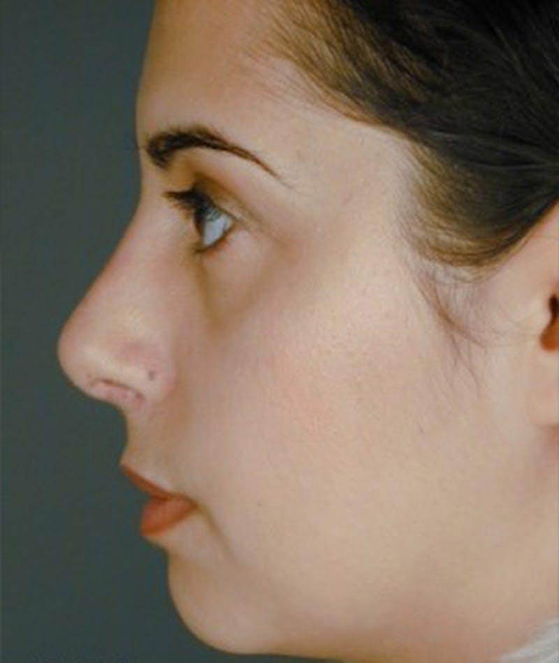 Primary Rhinoplasty Before & After Gallery - Patient 108174340 - Image 2