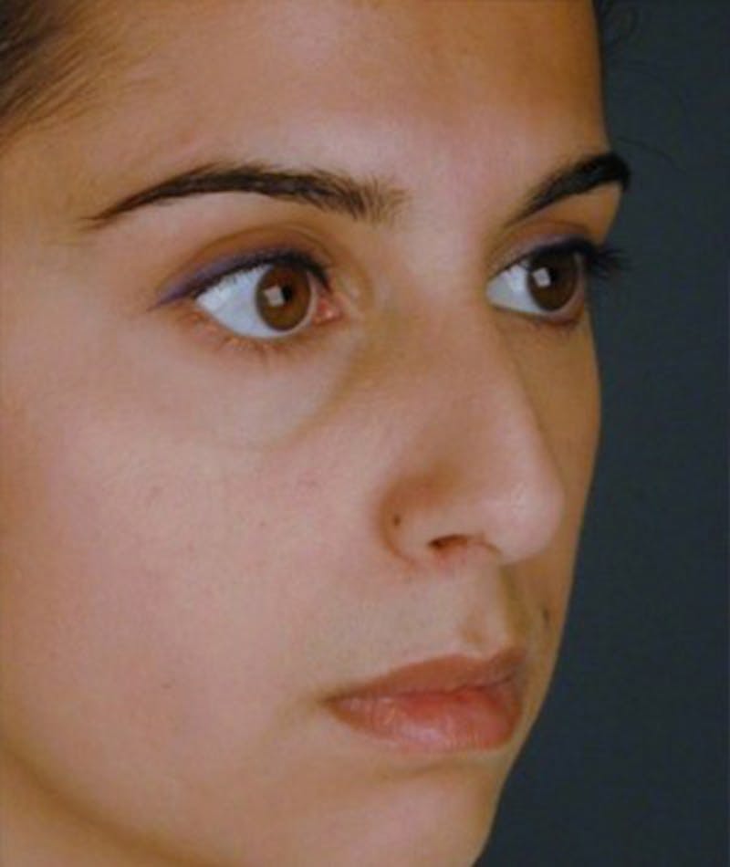 Primary Rhinoplasty Before & After Gallery - Patient 108174340 - Image 3