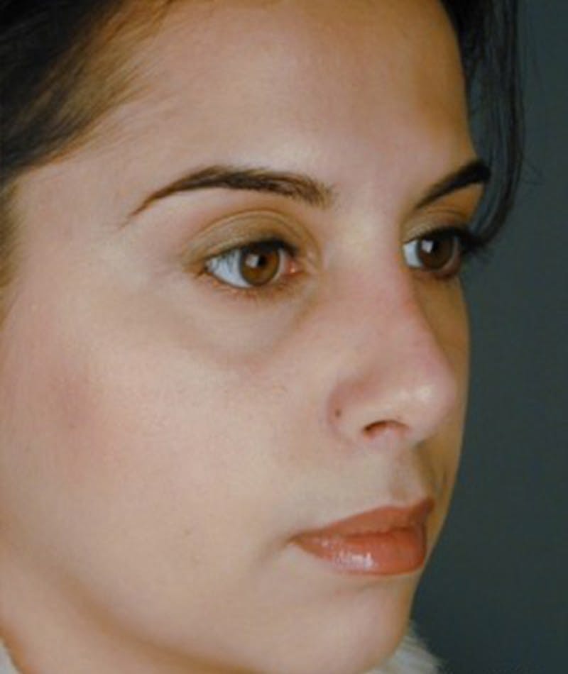 Primary Rhinoplasty Before & After Gallery - Patient 108174340 - Image 4