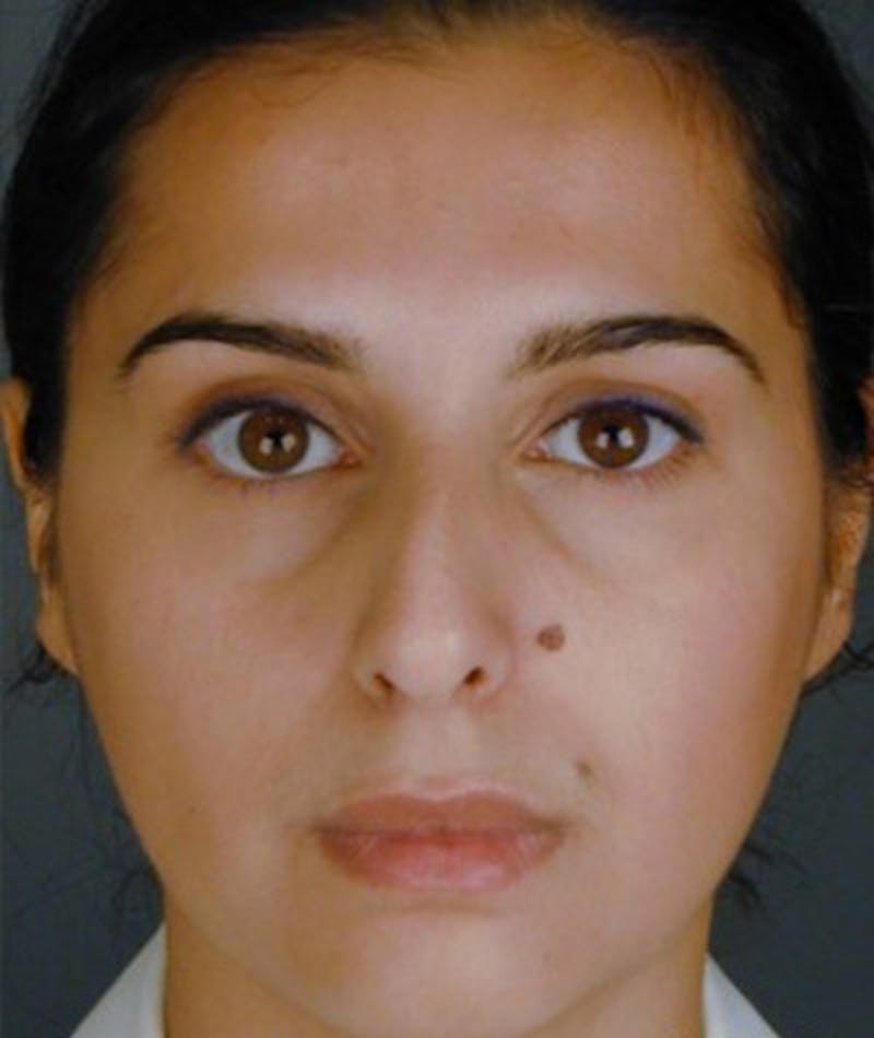 Primary Rhinoplasty Before & After Gallery - Patient 108174340 - Image 5