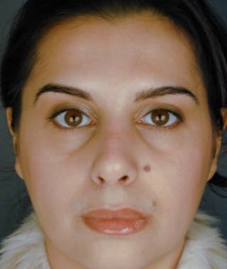 Primary Rhinoplasty Before & After Gallery - Patient 108174340 - Image 6