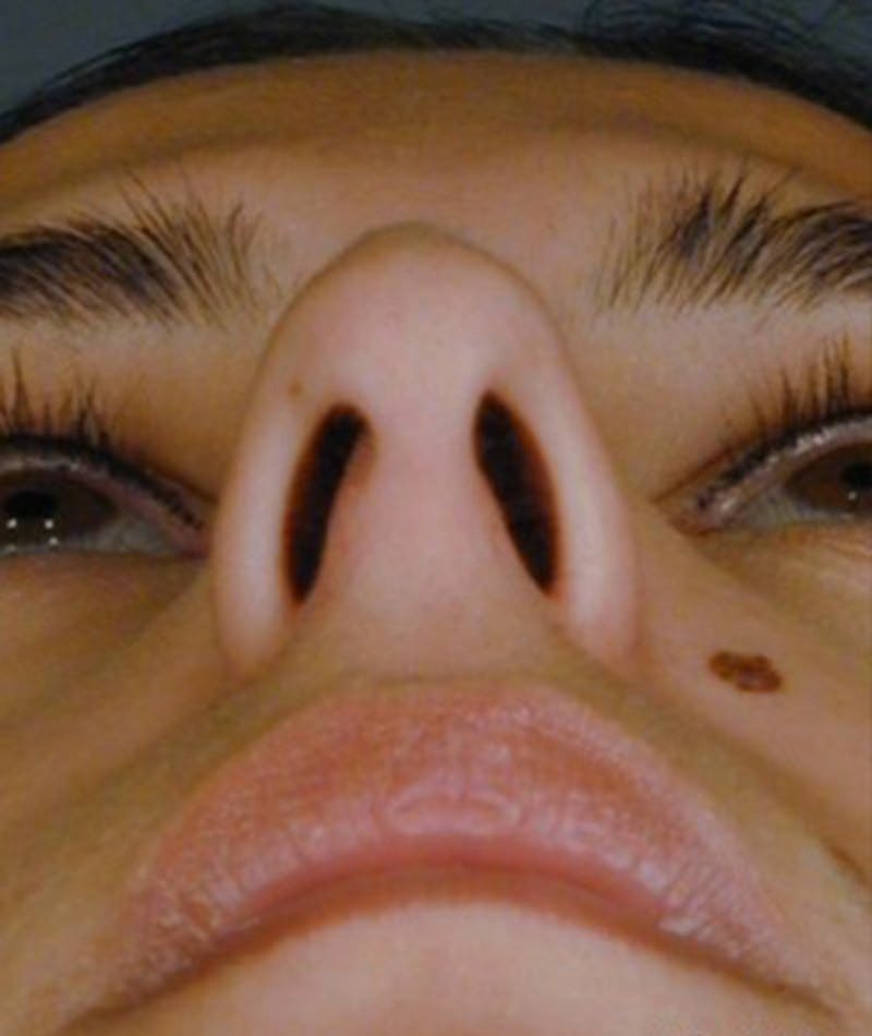Primary Rhinoplasty Before & After Gallery - Patient 108174340 - Image 7