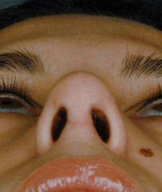 Primary Rhinoplasty Before & After Gallery - Patient 108174340 - Image 8