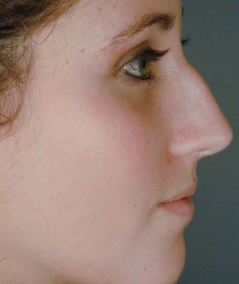 Primary Rhinoplasty Before & After Gallery - Patient 108174341 - Image 1