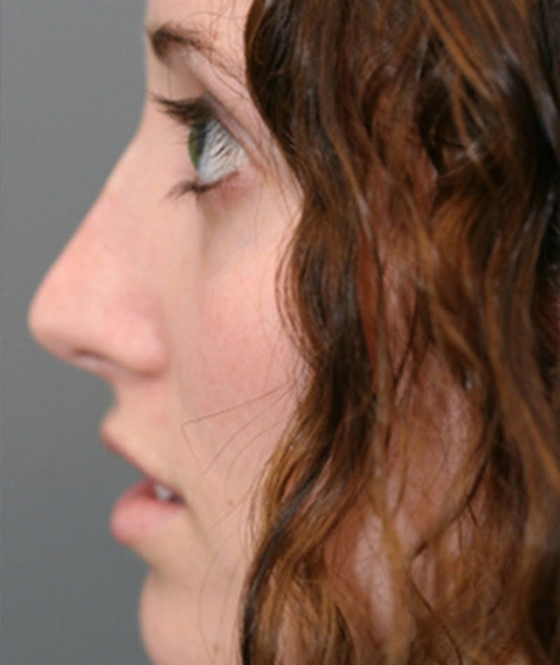 Primary Rhinoplasty Before & After Gallery - Patient 108174341 - Image 2