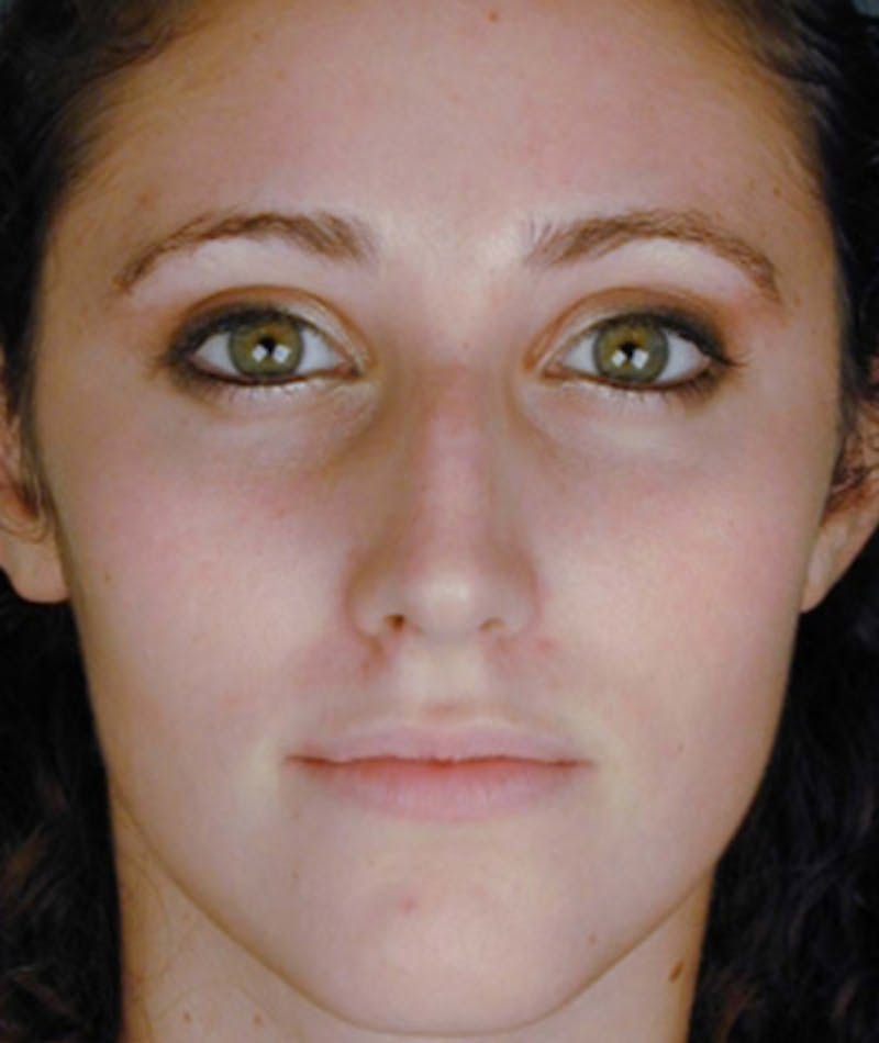 Primary Rhinoplasty Before & After Gallery - Patient 108174341 - Image 3