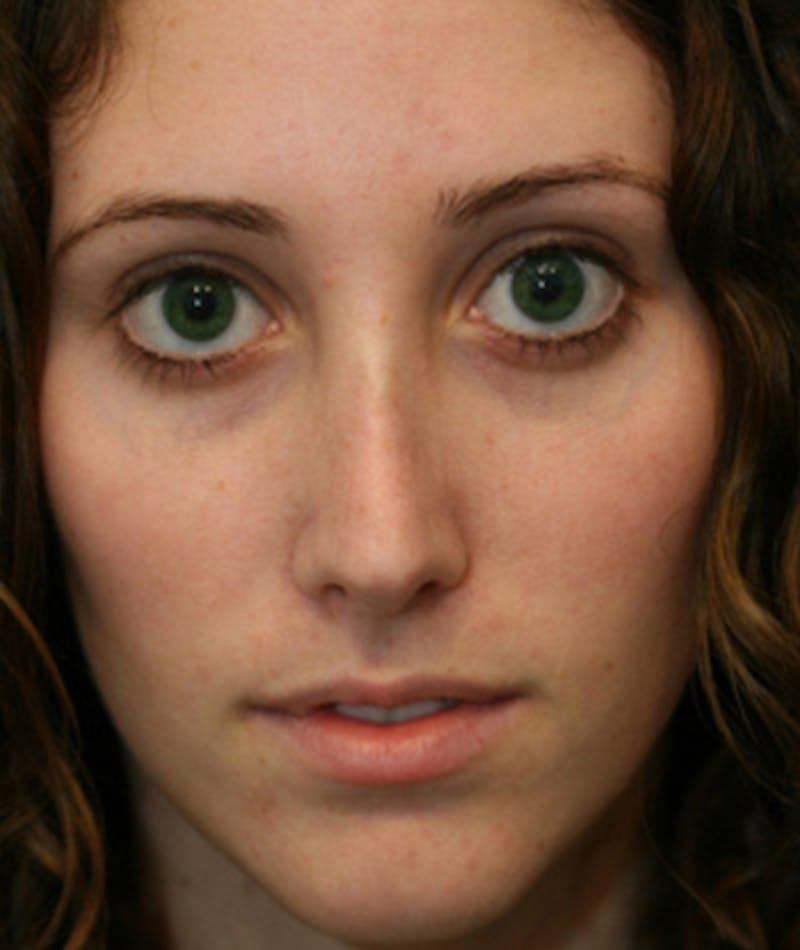 Primary Rhinoplasty Before & After Gallery - Patient 108174341 - Image 4