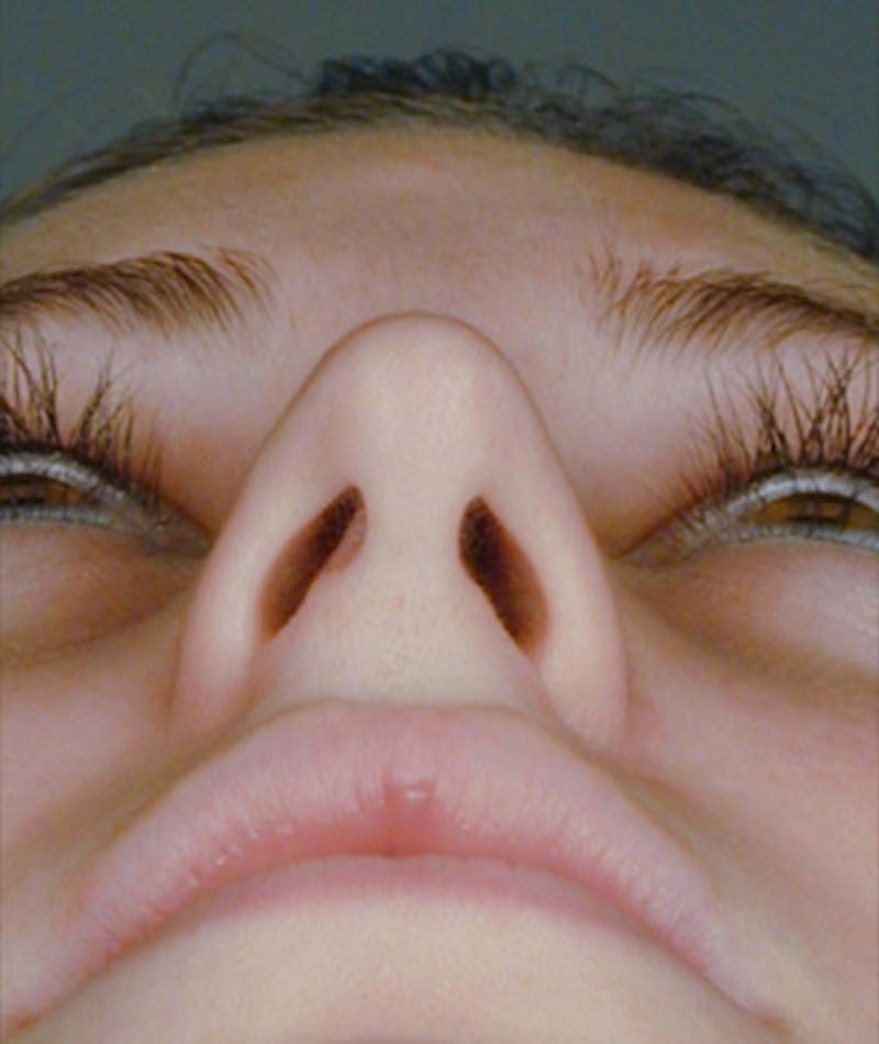 Primary Rhinoplasty Before & After Gallery - Patient 108174341 - Image 5