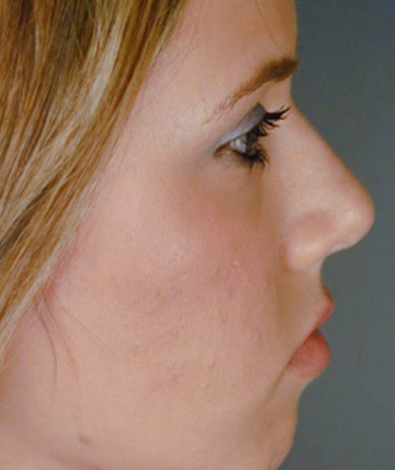 Primary Rhinoplasty Before & After Gallery - Patient 108174343 - Image 1