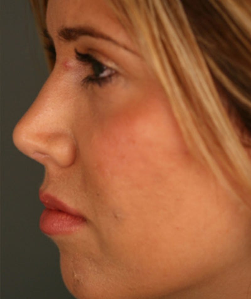 Primary Rhinoplasty Before & After Gallery - Patient 108174343 - Image 2