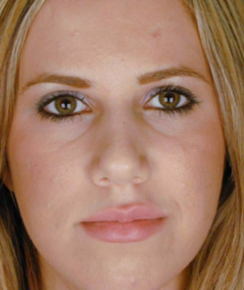 Primary Rhinoplasty Before & After Gallery - Patient 108174343 - Image 3