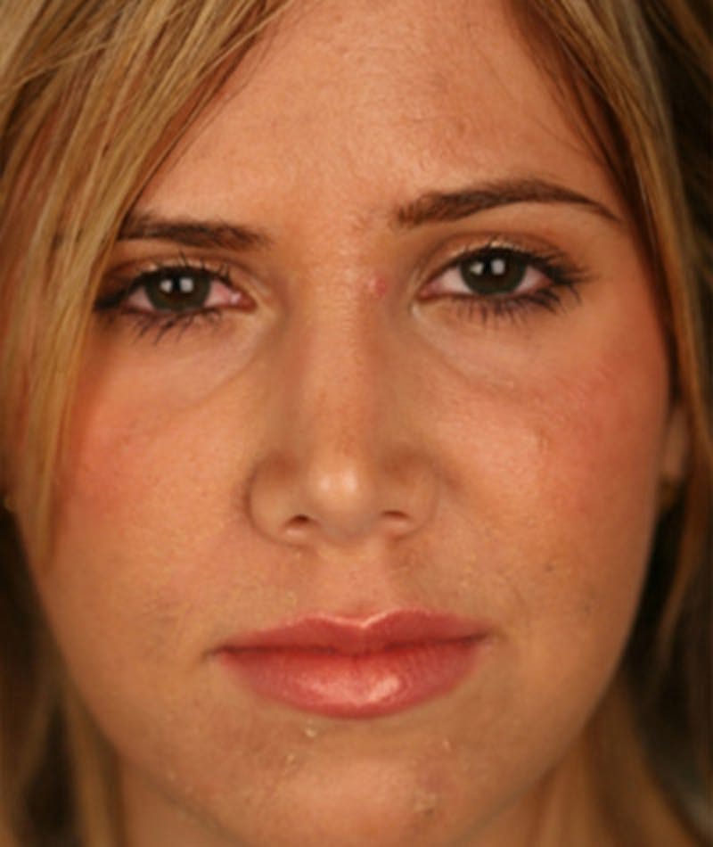 Primary Rhinoplasty Before & After Gallery - Patient 108174343 - Image 4