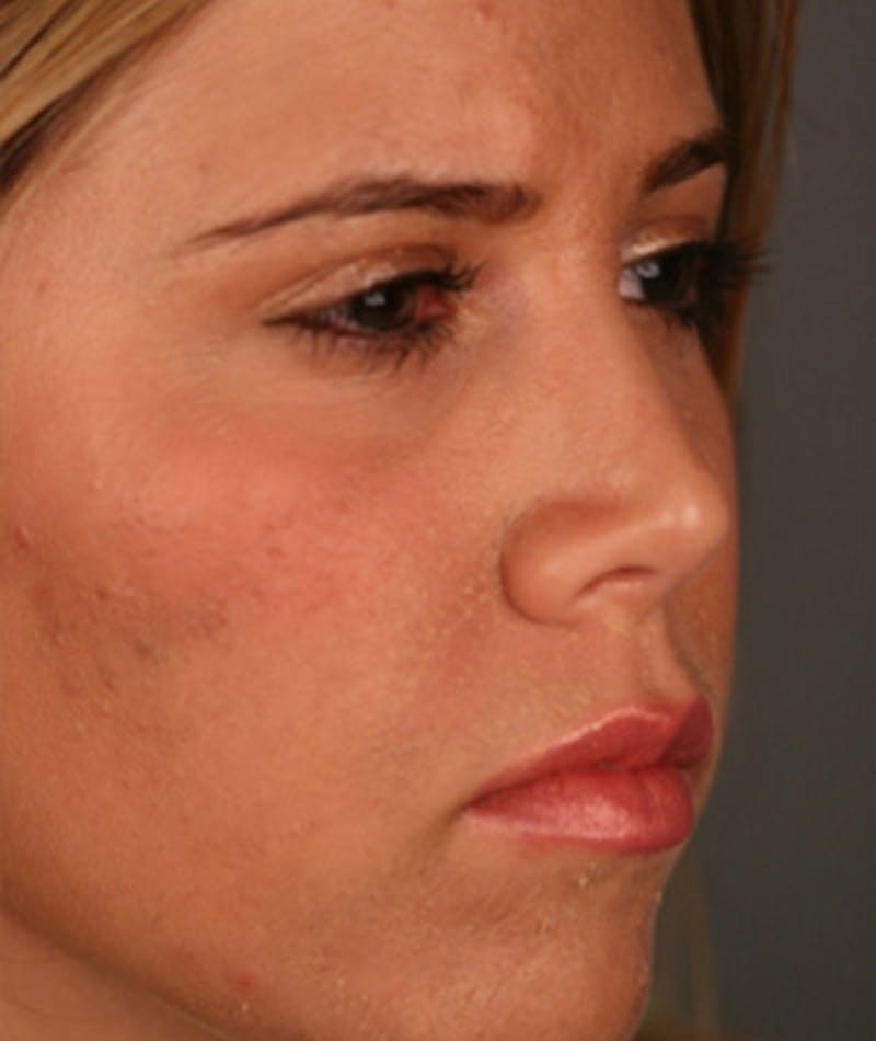 Primary Rhinoplasty Before & After Gallery - Patient 108174343 - Image 6