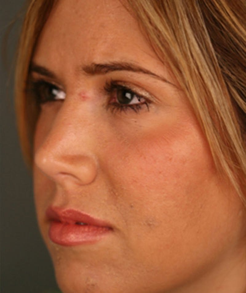Primary Rhinoplasty Before & After Gallery - Patient 108174343 - Image 8