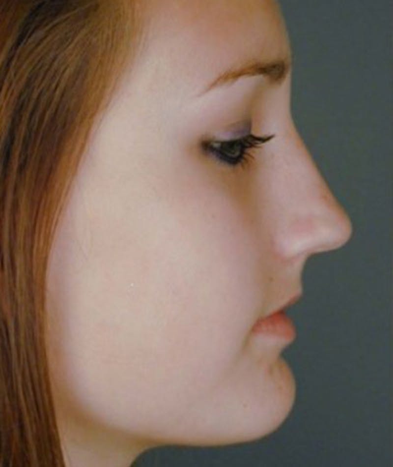 Primary Rhinoplasty Before & After Gallery - Patient 108174344 - Image 1