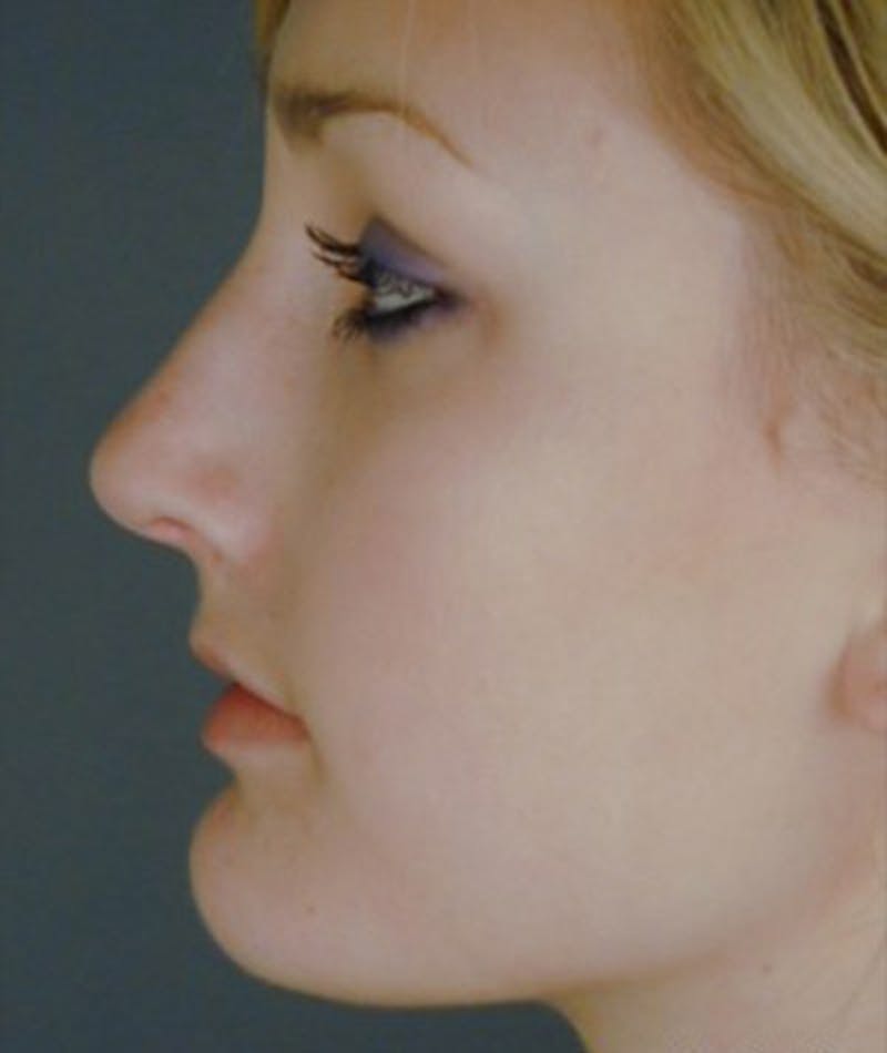 Primary Rhinoplasty Before & After Gallery - Patient 108174344 - Image 2